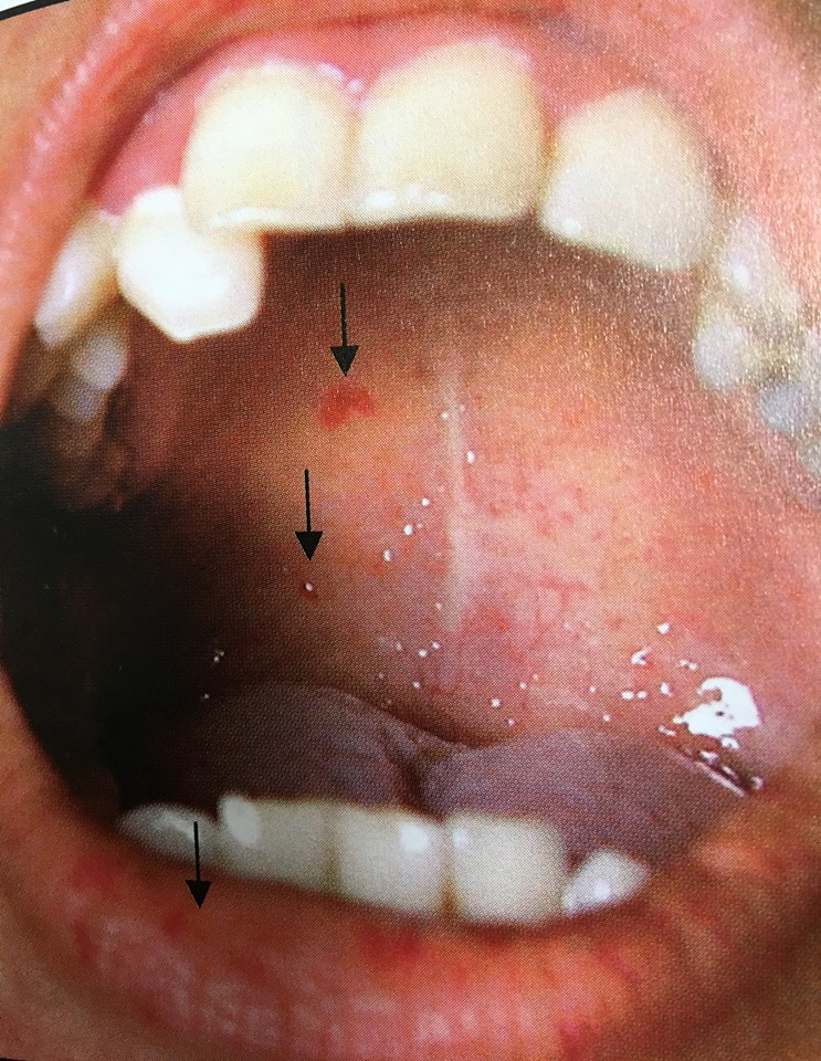 19959345_1737937419554000_752098292841198407_n